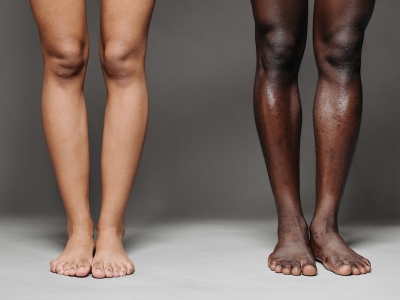 Salute del piede: soluzioni per calzature per la differenza di lunghezza delle gambe (LLD)