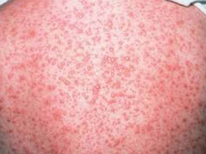 Varicella and co: cure naturali