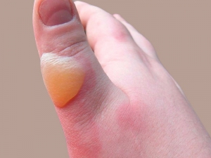 Ustioni e bambini: cosa fare