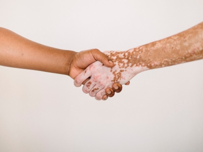 La vitiligine nei bambini: ciò che c'è da sapere