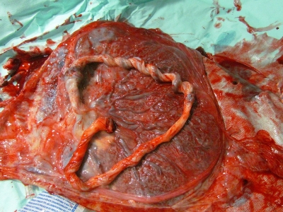 Cosa sono il secondamento e la placenta