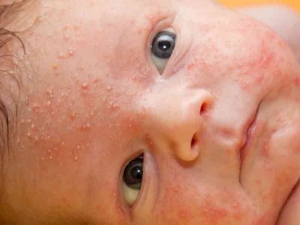 I rimedi naturali contro la sudamina